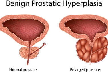 Triệu chứng cảnh báo nam giới bị phì đại tuyến tiền liệt