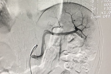Gây tắc động mạch cứu lá lách bị vỡ cho cô gái trẻ