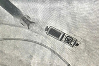 Thiết bị nhỏ bằng viên thuốc con nhộng giúp cụ bà 83 tuổi thoát đột tử