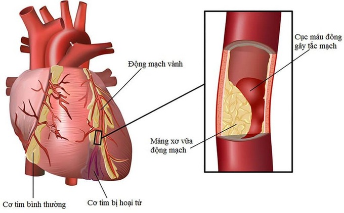 Cảnh giác nguy cơ ngừng tuần hoàn đột ngột và cách phòng tránh - Ảnh 1.