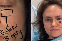 Tưởng nốt mụn dưới mắt, hóa là ung thư da