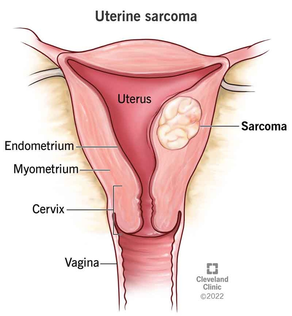 Sarcoma tử cung: Triệu chứng và dấu hiệu nhận biết - 1 Sarcoma tử cung: Triệu chứng và dấu hiệu nhận biết - 1