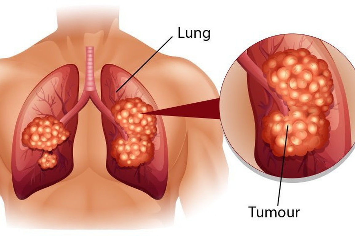Các triệu chứng ung thư phổi ở nam giới - 1 Các triệu chứng ung thư phổi ở nam giới - 1