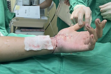 Chàng trai bị dao tự chế chém gần lìa cổ tay trái ở Tây Ninh