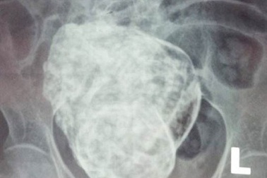 Hội chẩn liên viện trường hợp cụ bà mang “thai đá” gần 30 năm