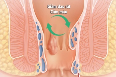 Bệnh trĩ - Cách phòng tránh và chữa trị