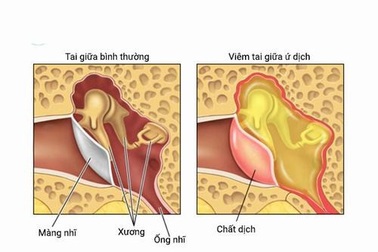 Làm gì khi trẻ bị viêm tai giữa ứ dịch?