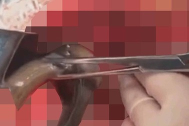 Nguy kịch vì nuốt 2 con lươn sống để chữa táo bón