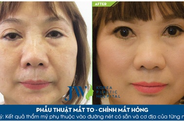 Cắt mí Hàn Quốc miễn phí cùng TS. BS. Nguyễn Phan Tú Dung