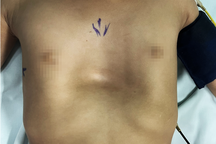 Hy hữu bé gái 3 tuổi có lồng ngực lõm như chiếc chén, đặt vừa quả trứng vịt