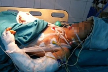 Bé 9 tuổi bị cướp chém đứt tay tạm qua cơn nguy kịch
