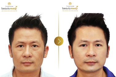 Chuyên gia làm đẹp tư vấn chi tiết về công nghệ nâng cơ chỉ bằng vàng