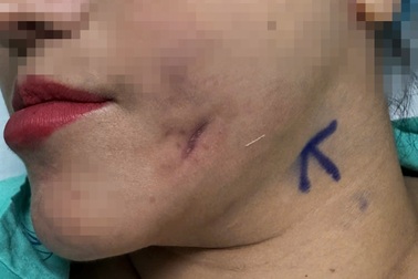 Người phụ nữ từ Hà Nội vào TPHCM cầu cứu vì gò má bỗng dưng chảy mủ