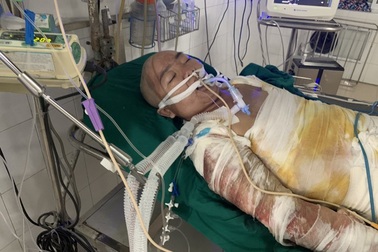 Đau nhói lòng cảnh người mẹ đi kiếm cái ăn nuôi 3 con bị ngã vào bếp hấp cá