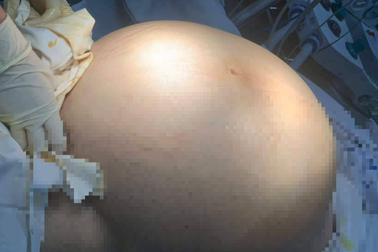 Nữ sinh từ Canada về TPHCM cấp cứu trong đêm với khối u 22kg ở bụng