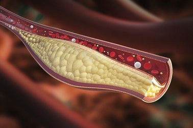 Điều trị rối loạn lipid máu như thế nào?