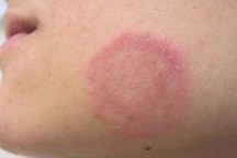 Một bệnh viện từng xảy ra vụ dịch nhiễm nấm khiến 11 người tử vong