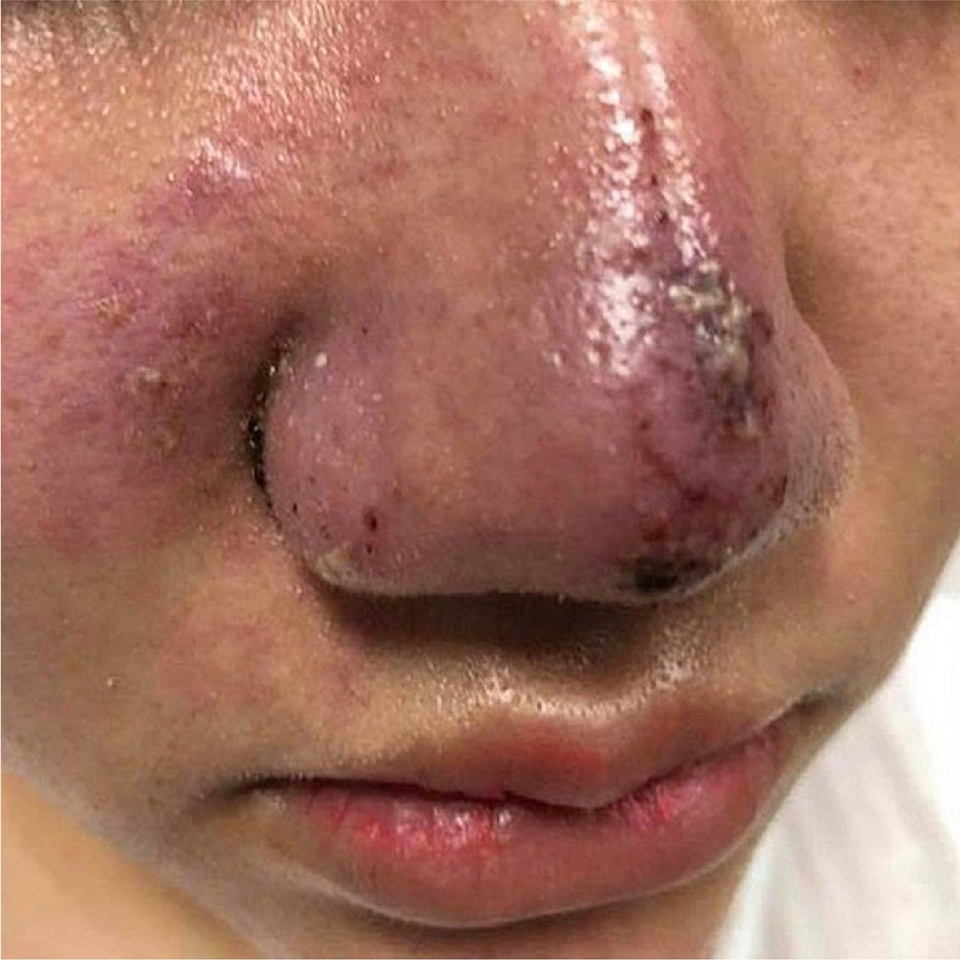 Làm mũi xong người xinh bội phần, người mũi vẹo ngược. Nguyên nhân do đâu? - 1 Làm mũi xong người xinh bội phần, người mũi vẹo ngược. Nguyên nhân do đâu? - 1