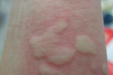 Thực hư cháu bé nổi mẩn đỏ khắp người sau khi uống trà sữa