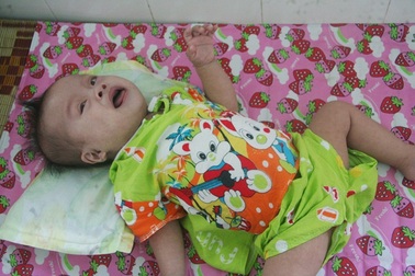 Ngằn ngặt tiếng khóc xé lòng của cháu bé 1 tuổi bị bệnh "đao" và tim nặng