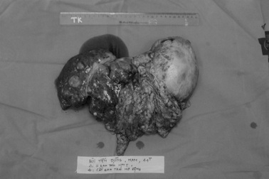 Tình cờ phát hiện, u gan đã nặng 2,5kg