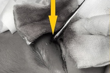 Bé trai bị thanh sắt đâm thấu hốc mắt, xuyên não