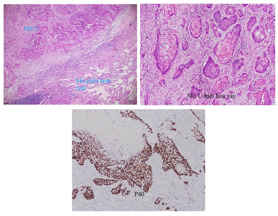 Hiếm gặp: Phát hiện 2 loại ung thư trên cùng một thùy phổi - 2