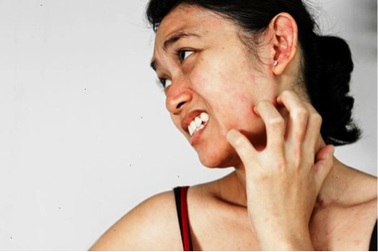 Dễ tái phát mề đay mẩn ngứa khi giao mùa