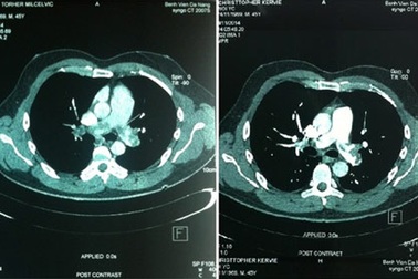 Cứu du khách người Australia tắc động mạch phổi cấp nguy kịch