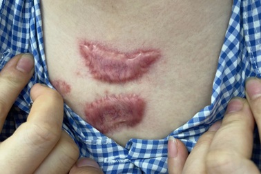 Sẹo lồi to gấp đôi sau khi chi 30 triệu đồng chữa sẹo tại spa