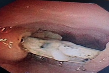 Xương gà xuyên thủng thực quản, bác sĩ chẩn đoán ngộ độc thực phẩm