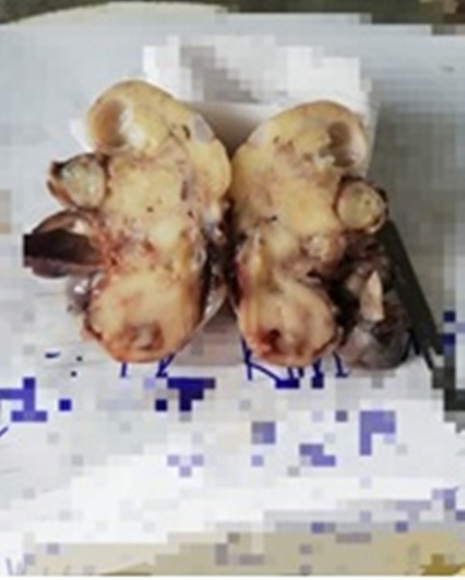 Phẫu thuật thành công ca bệnh thai trong thai hiếm gặp - 1 Phẫu thuật thành công ca bệnh thai trong thai hiếm gặp - 1