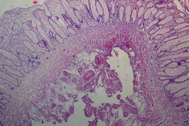 Nội soi cắt u lành bằng kỹ thuật mới, ngừa tái phát