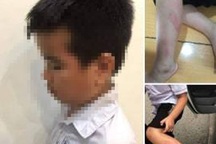 Đánh học sinh lớp 2 sưng tấy, bầm tím chân, cô giáo bị tạm đình chỉ công tác