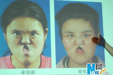 Phẫu thuật cấy ghép cho bệnh nhân “mặt lõm”