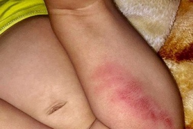 Bé gái 16 tháng tuổi bầm tím hai đùi sau khi từ nhà trẻ về