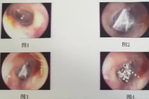 Nhện sống trong ống tai người phụ nữ Trung Quốc