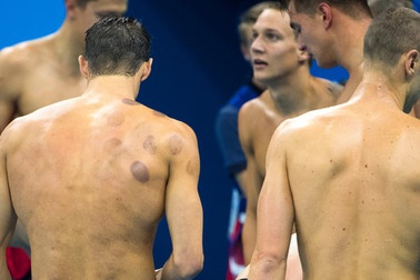 Giác hơi: Bí quyết thành công của kình ngư Mỹ Michael Phelps?