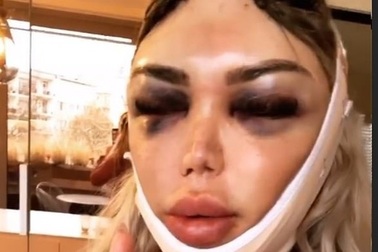 Roddy Alves lộ mặt sưng phồng sau phẫu thuật