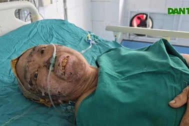 Em gái bệnh tim khóc ngất trước phòng hồi sức xin cứu chị ruột bỏng nặng