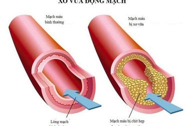Biến chứng xơ vữa động mạch do rối loạn lipid máu nguy hiểm ra sao?