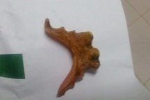 Thủng đại tràng vì hàm răng giả rơi vào bụng