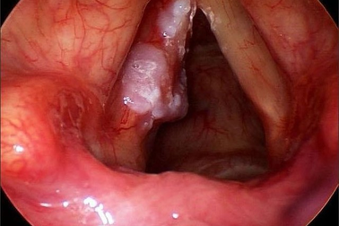 Bị khàn tiếng, mất giọng coi chừng bệnh lý nguy hiểm!