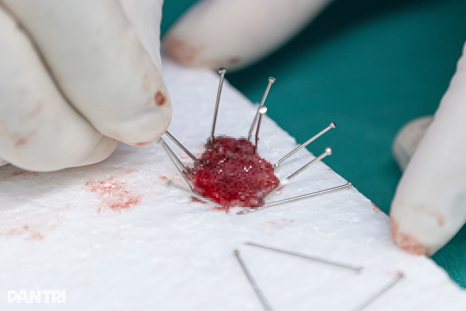 Xem bác sĩ thâm nhập dạ dày truy vết ung thư - 1 Xem bác sĩ thâm nhập dạ dày truy vết ung thư - 1