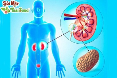 Giảm nguy cơ sỏi thận hình thành và phát triển nhờ thực phẩm
