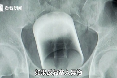 Giải cứu bệnh nhân bị kẹt chiếc cốc dài 8cm trong trực tràng