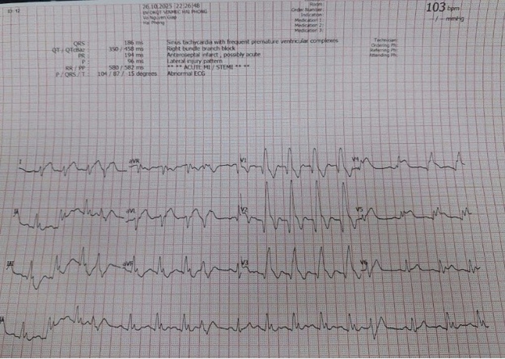 Cứu bệnh nhân người Trung Quốc nhồi máu cơ tim khi đang chơi cầu lông - 1 Cứu bệnh nhân người Trung Quốc nhồi máu cơ tim khi đang chơi cầu lông - 1