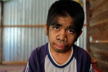 “Cậu bé người sói” được tôn sùng như vị Thánh ở Indonesia