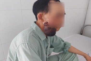 Khối u "khủng" tái phát hai lần trên mặt người đàn ông