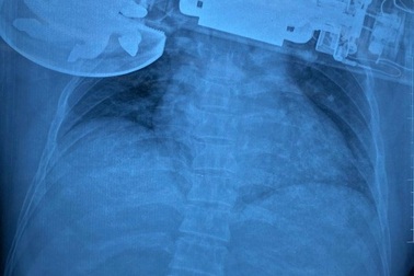 Vào viện cấp cứu, người đàn ông ôm theo máy chà cắm găm vào ngực